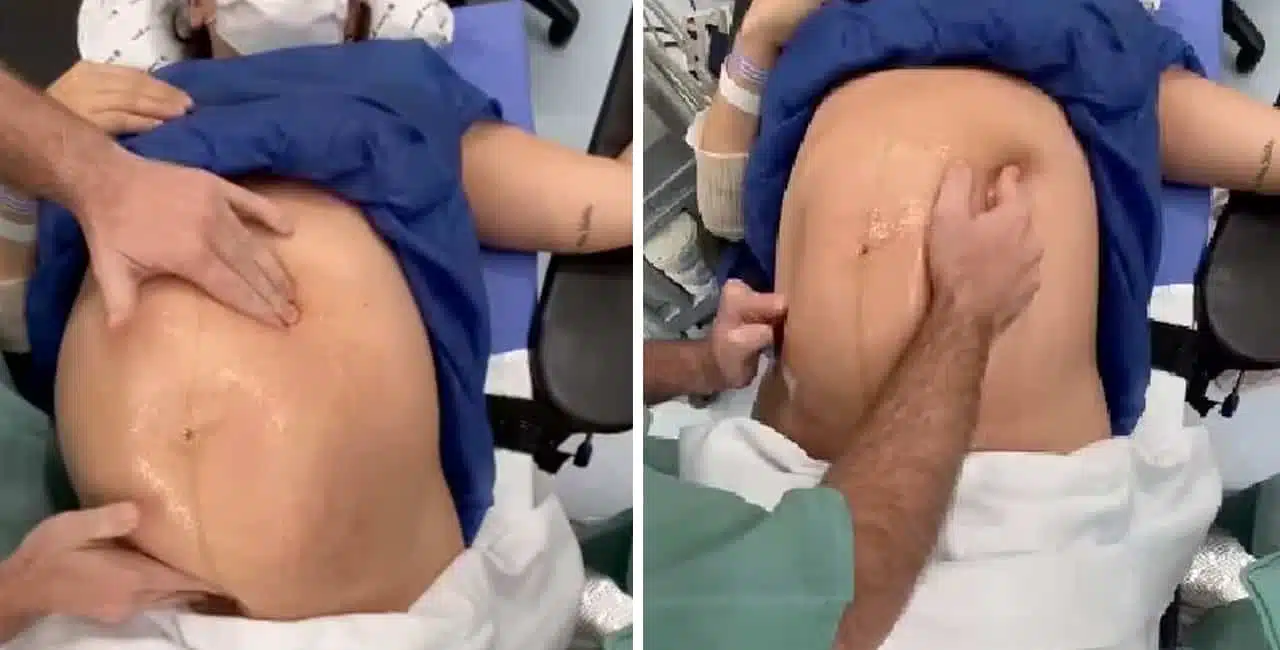 Com Muito Cuidado E Técnica, O Médico Brasileiro Vai Virando O Bebê Na Barriga Da Mãe Até Ele Se Encaixar Para O Parto Normal.