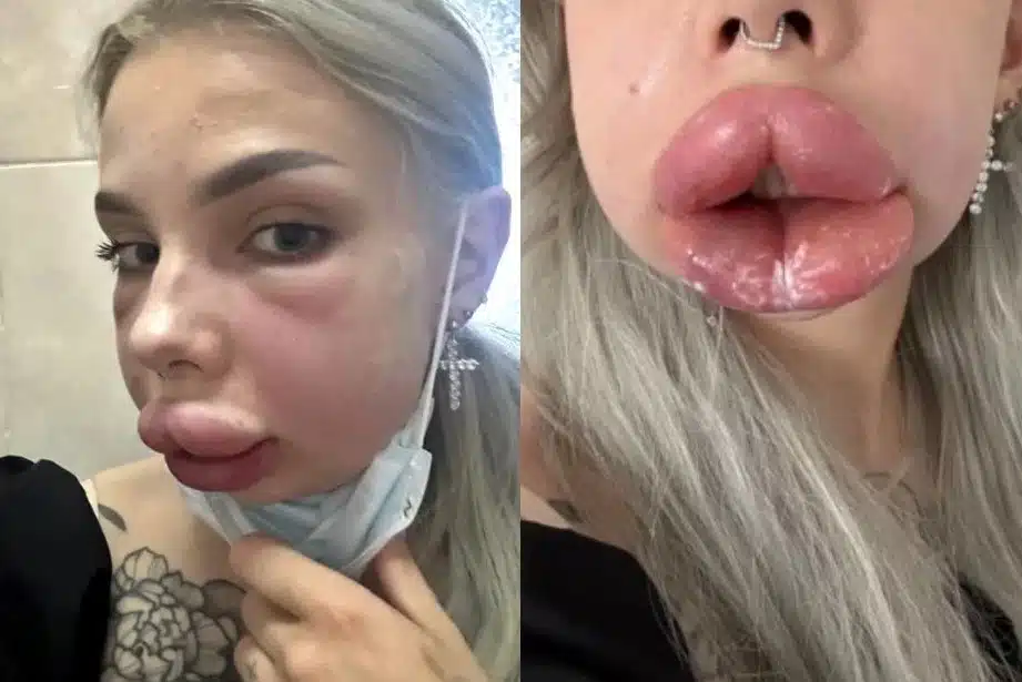 Influenciadora Russa Enfrenta Grave Reação Alérgica Após Procedimento Estético Nos Lábios