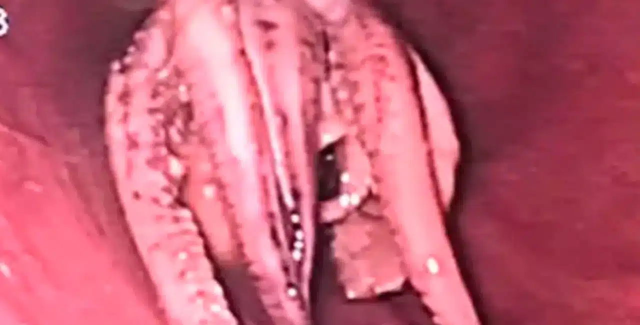 Vídeo Mostra Momento Em Que Médicos Encontram Polvo Na Garganta De Paciente