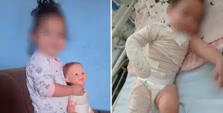 Bebê Sofre Queimadura Em Parte Do Corpo Por Derrubar Panela Com Caldo De Feijão Quente