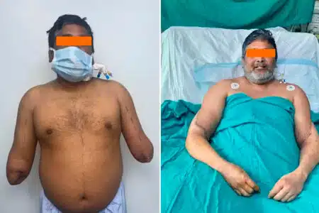 Indiano Recupera As Mãos Em Transplante Complexo