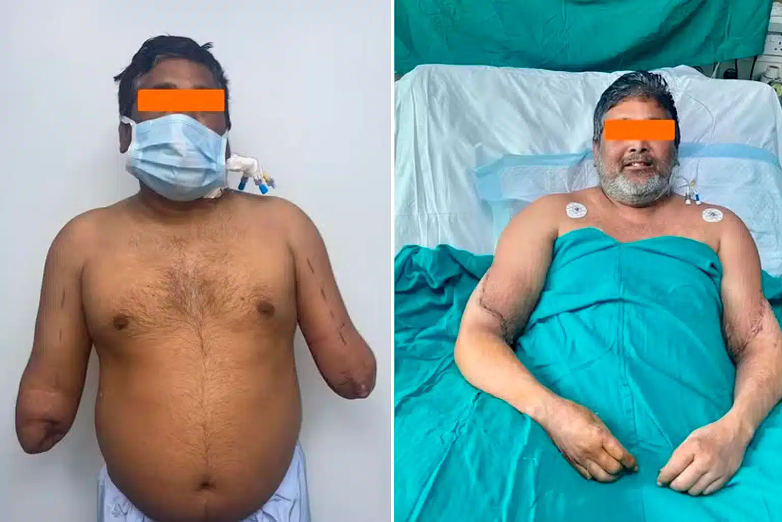 Indiano Recupera As Mãos Em Transplante Complexo