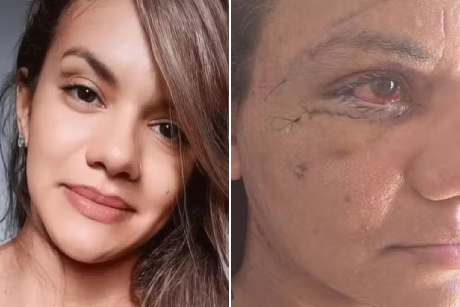 Mulher agredida com 61 socos em elevador mostra como está o seu rosto sete dias após cirurgia