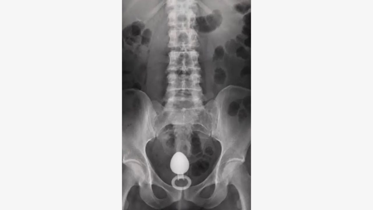 “Entrei em desespero”: influenciadora conta drama após acessório ficar preso no corpo; veja “Entrei Em Desespero”: Influenciadora Conta Drama Após Acessório Ficar Preso No Corpo; Veja