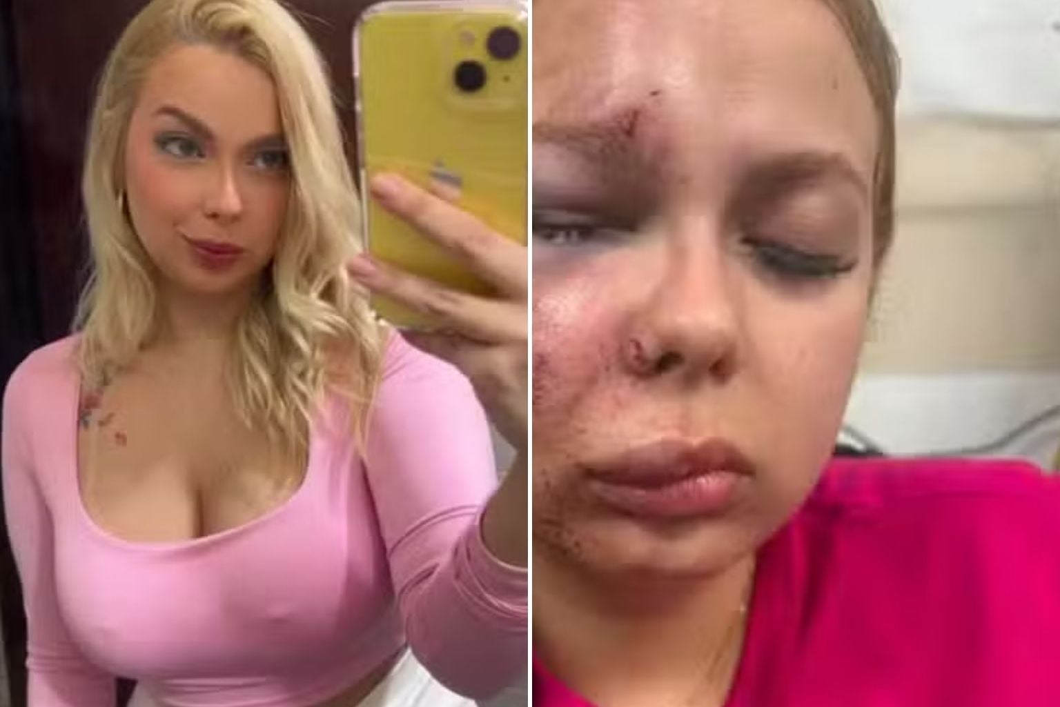Mulher É Espancada No Metrô De Sp E Sofre Fraturas No Maxilar, Nariz E Joelhos